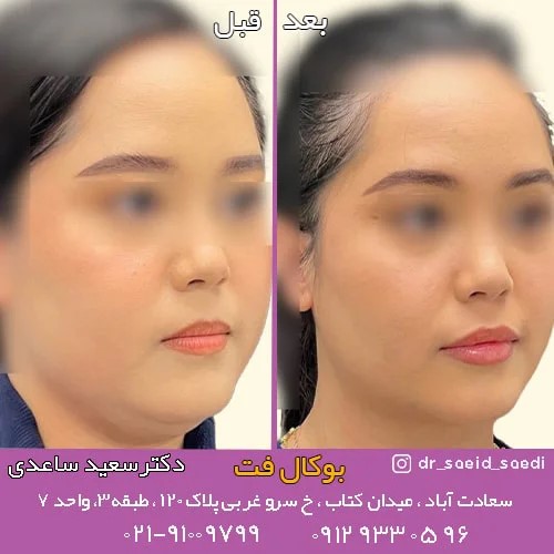 آیا عمل بوکال فت عوارضی دارد؟