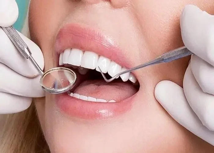 دلایل افتادن یا شکستن لمینت دندان چیست؟