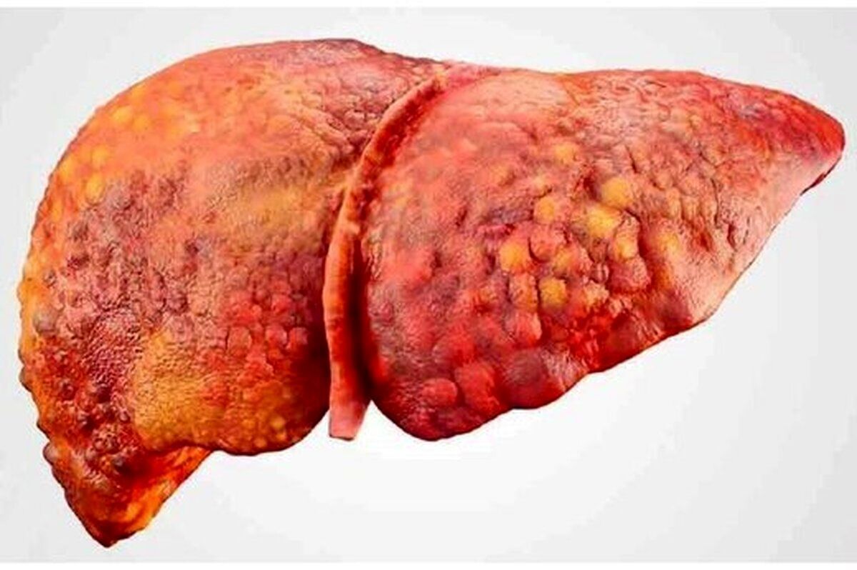 علامت مهم و زنگ خطر بیماری‌های کبد